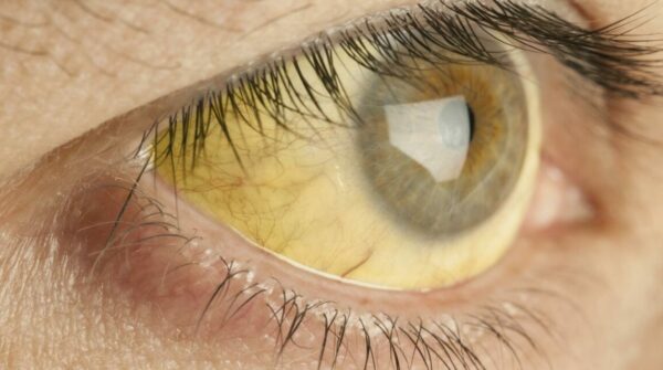 Oog met gele verkleuring van het oogwit